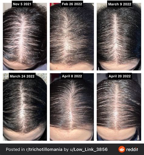 Exactly how it works is still a bit of a mystery, though many theories abound. . Hgh hair loss reddit